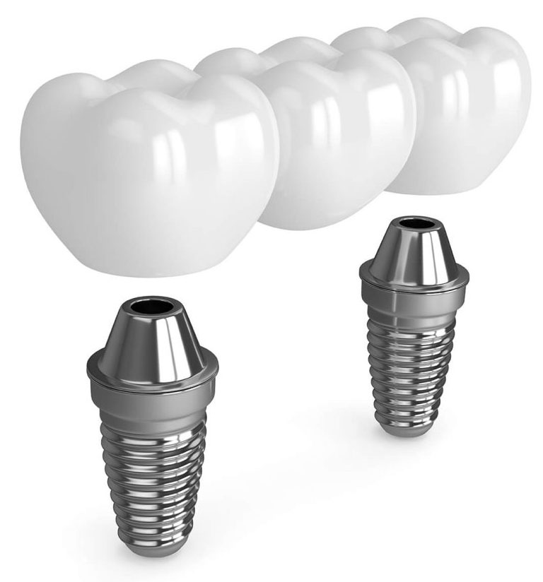 Multiple Dental Implants in Schaumburg & Norridge IL | Royal Dental Care