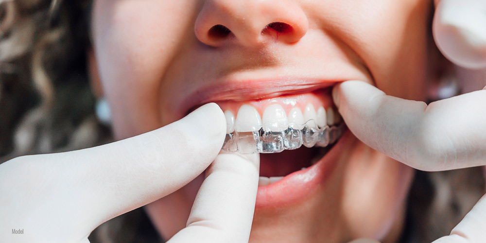 close up teeth with Invisalign®