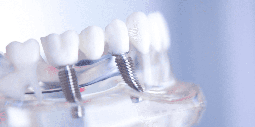 multiple dental implants