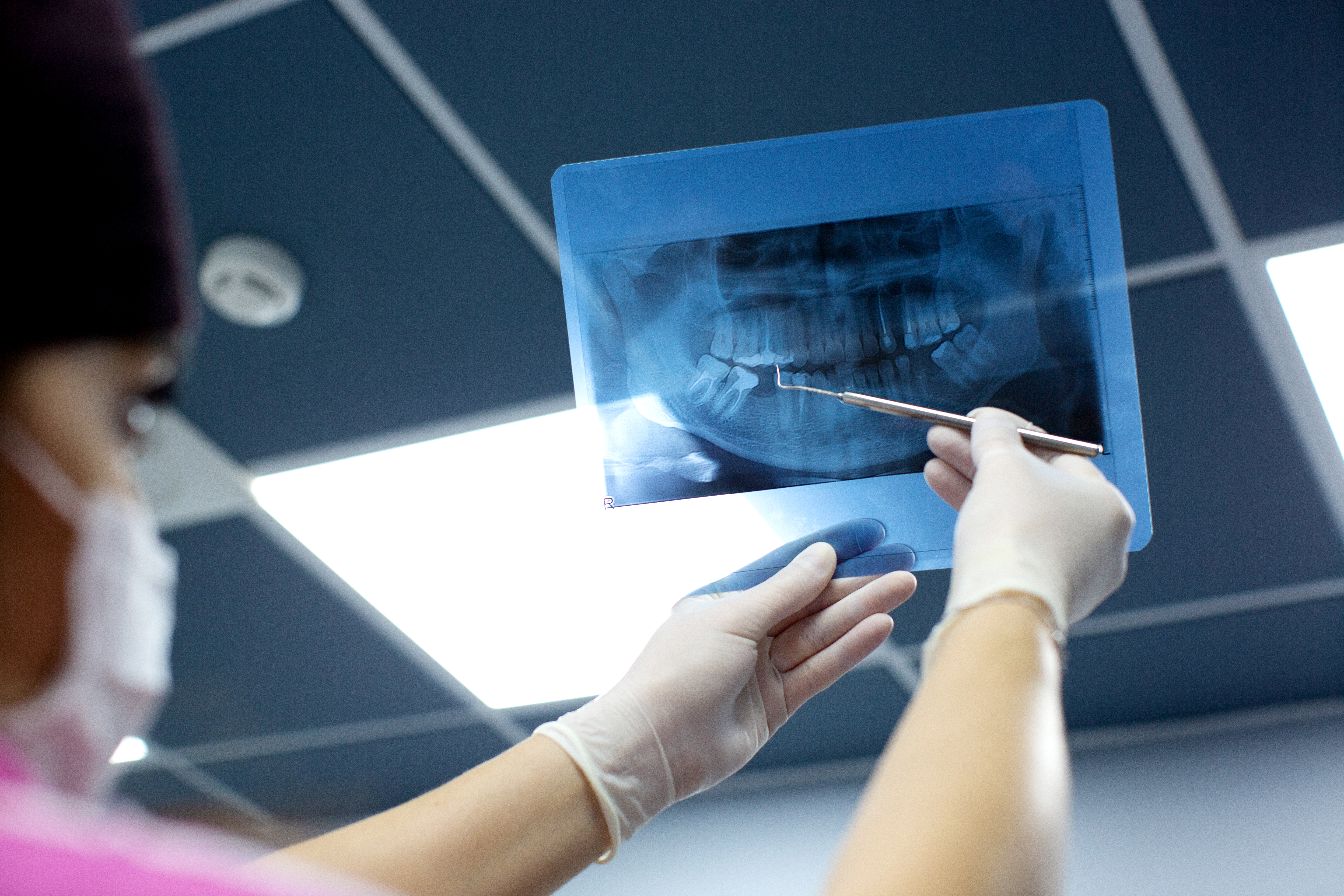 Why Dental X-Rays Are Safe and Essential for Your Oral Health