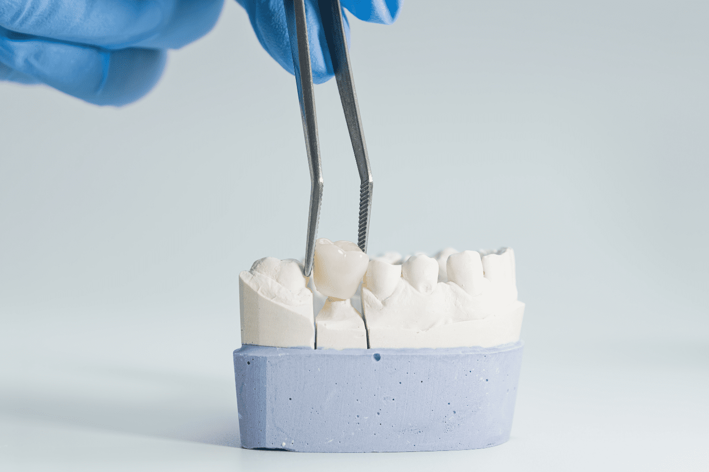 Dental crown lengthening model showing crown placement for restorative treatment