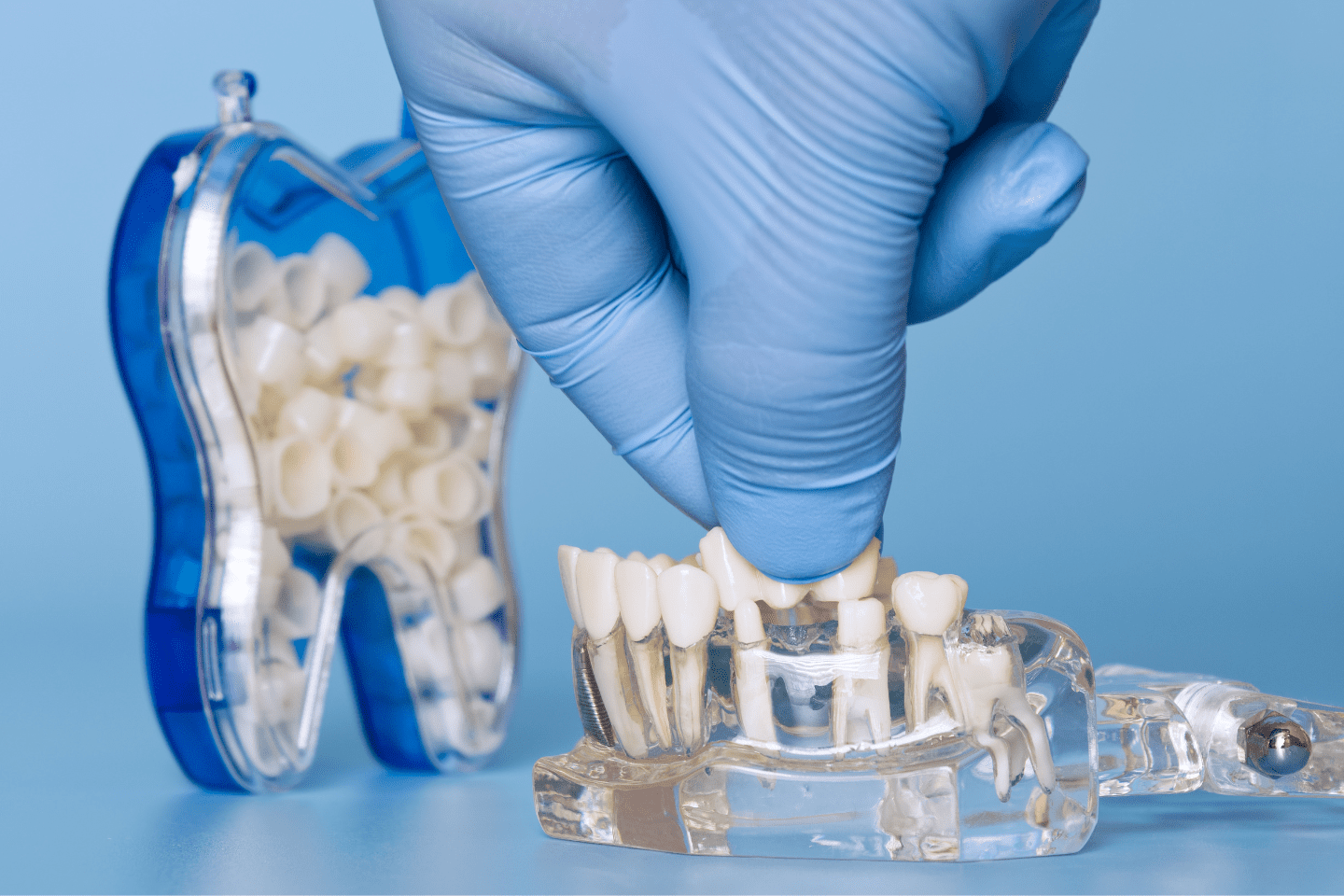 Is a Dental Bridge Permanent? | Royal Dental Care Norridge