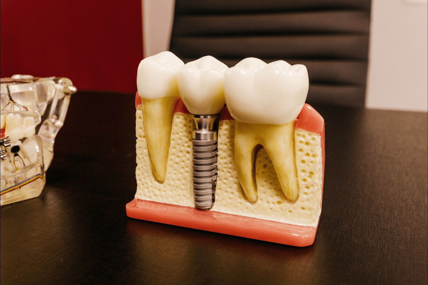 Dental implant model showing single tooth replacement in Schaumburg