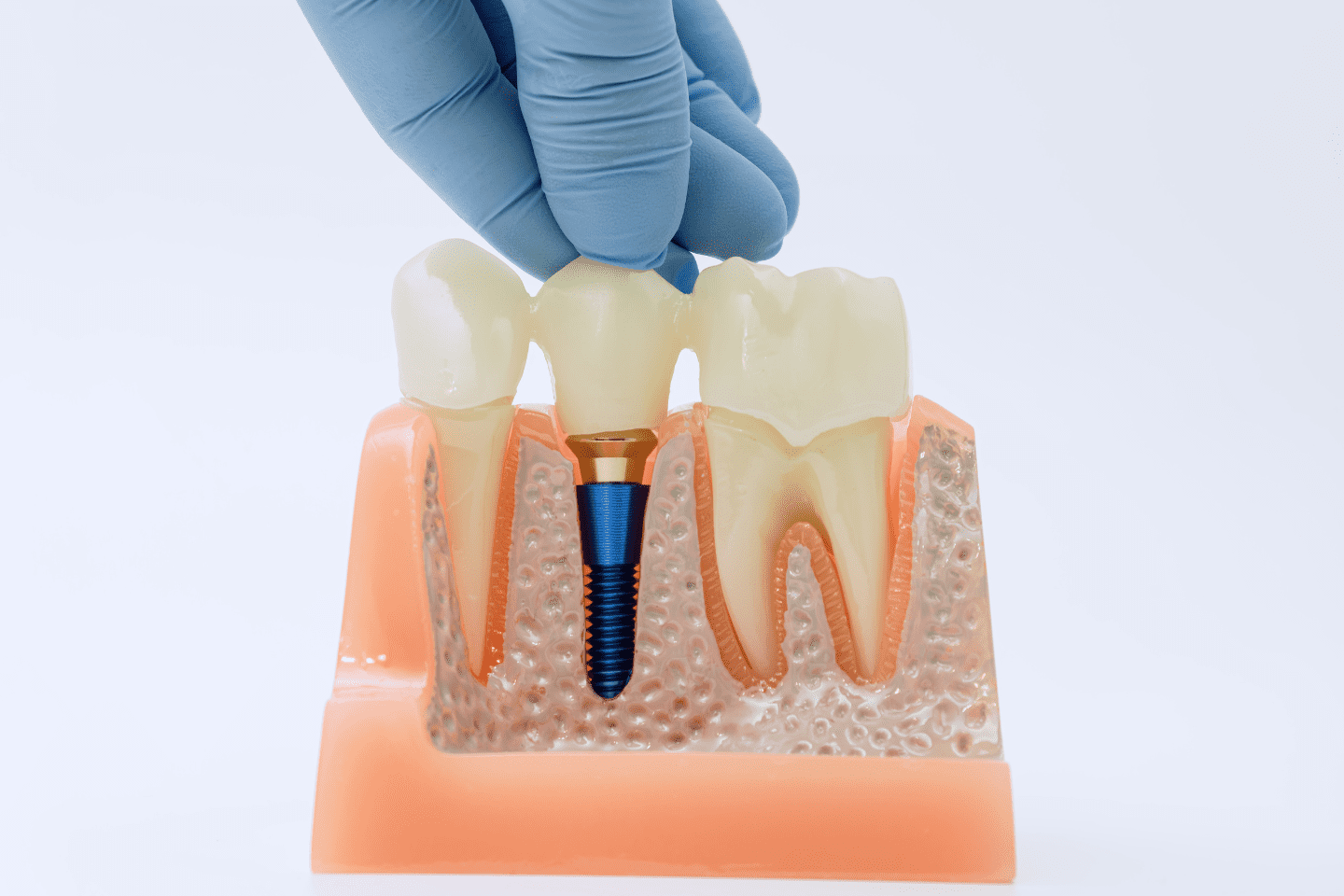 Can I Eat Normally with a Dental Bridge? | Norridge Guide