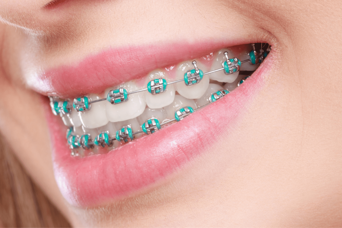 Can Braces Help with Sleep Apnea? Orthodontic Solutions