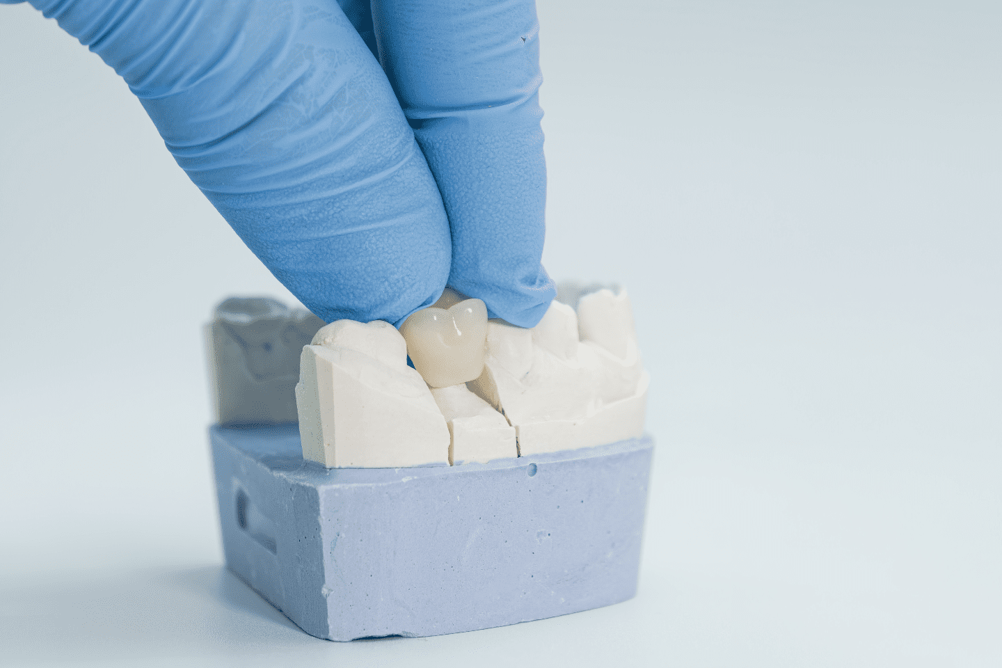 Does Dental Insurance Cover Crowns? Schaumburg Guide