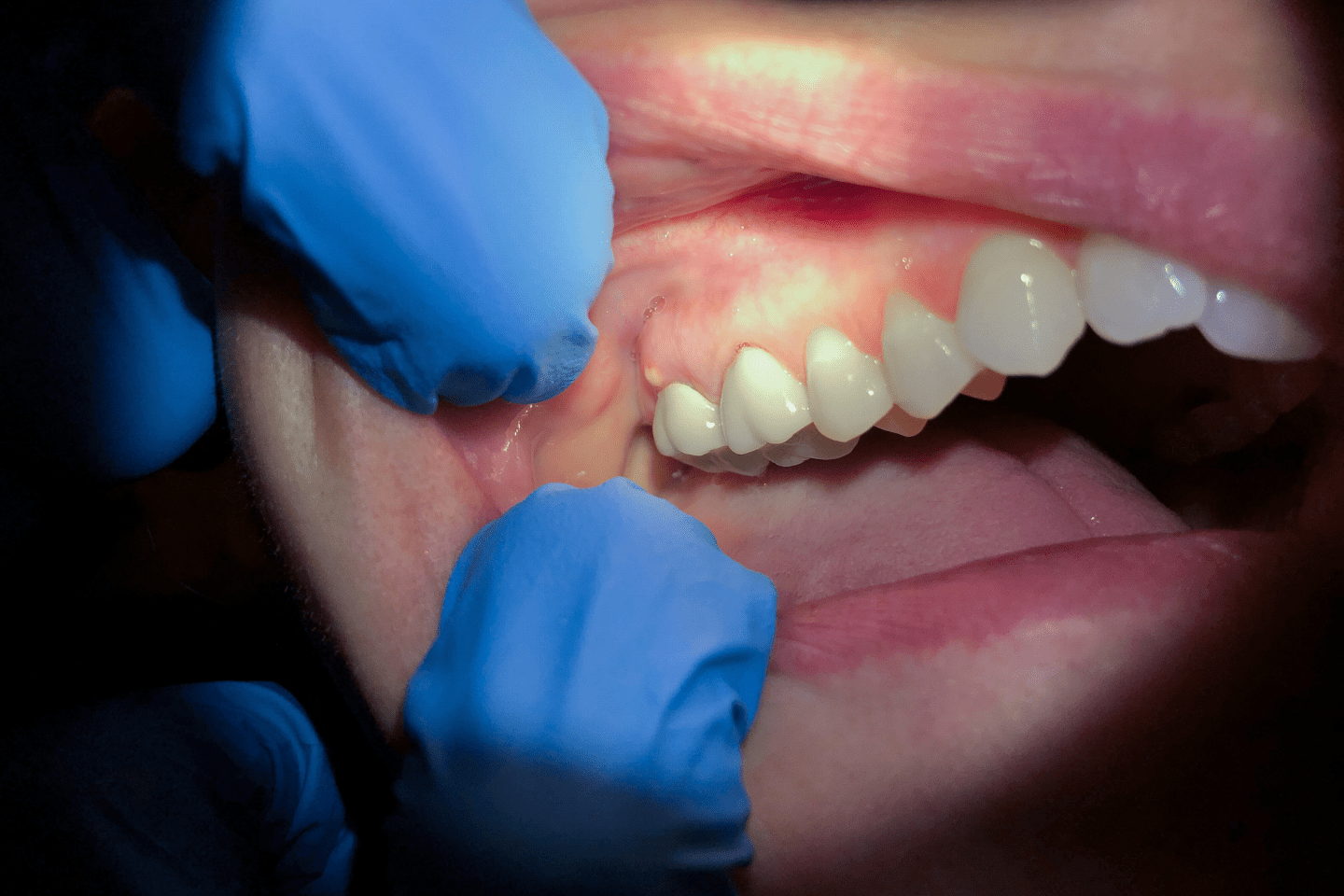 Dental Abscess or Toothache? Know the Signs