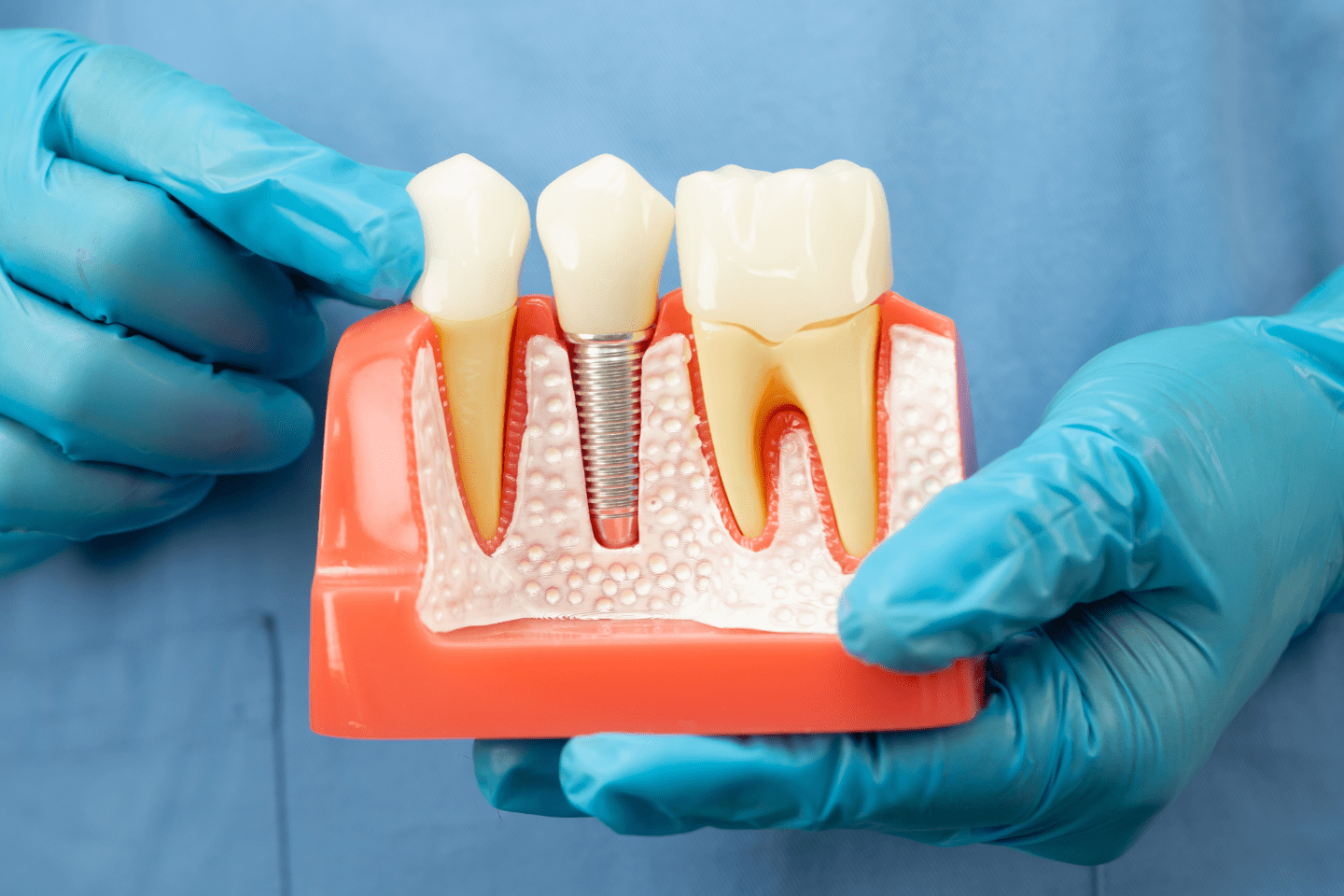 Dental Bridge vs. Implant: Which is Better?