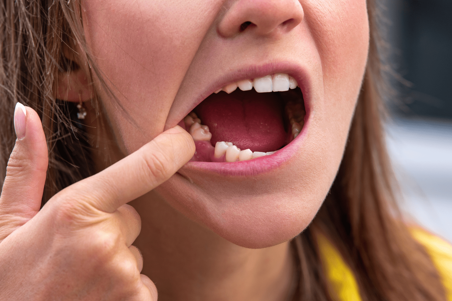 Understanding Dry Socket After Extraction