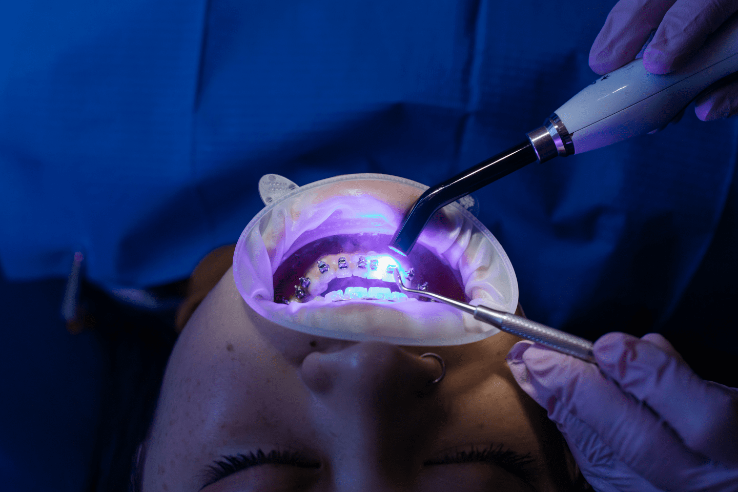 What is Laser Gum Contouring?