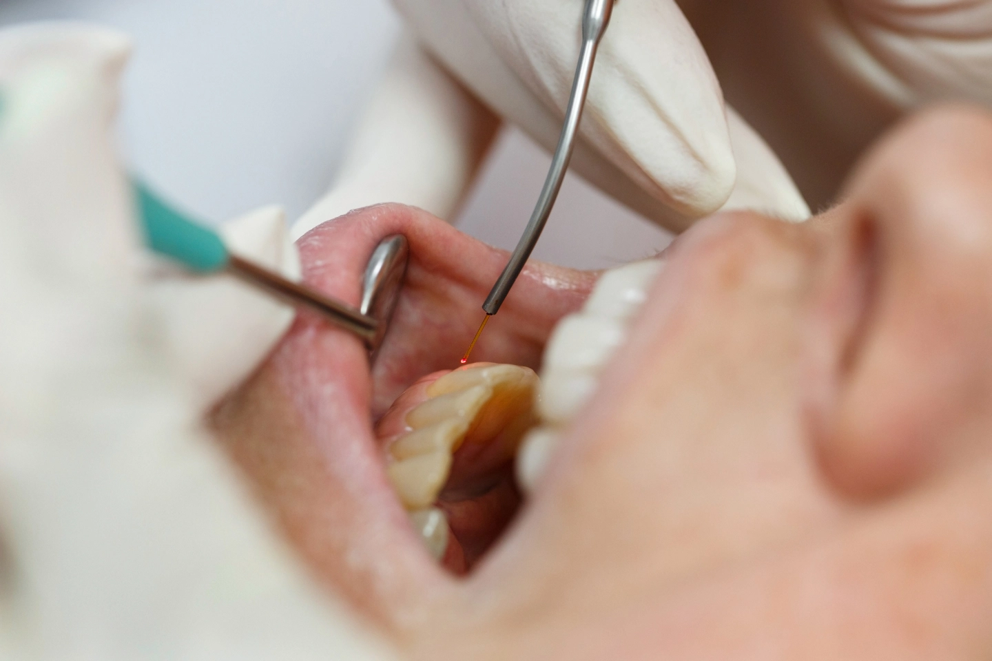 Dental laser being used on gum tissue during LANAP